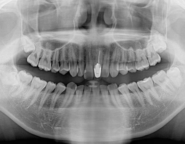難しい親知らず抜歯
