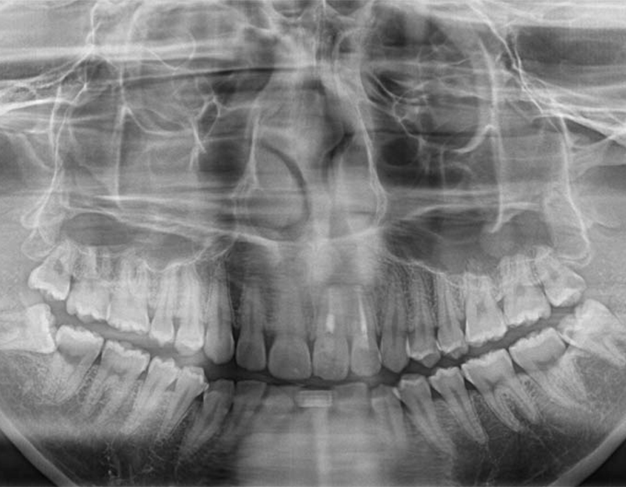 親知らず専門外来症例1