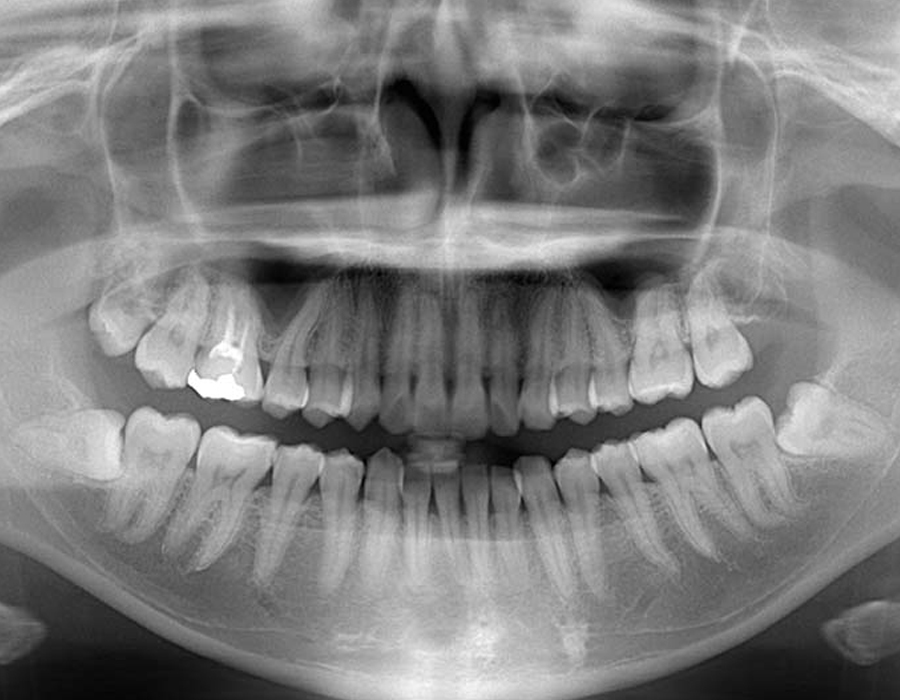 親知らず専門外来症例3